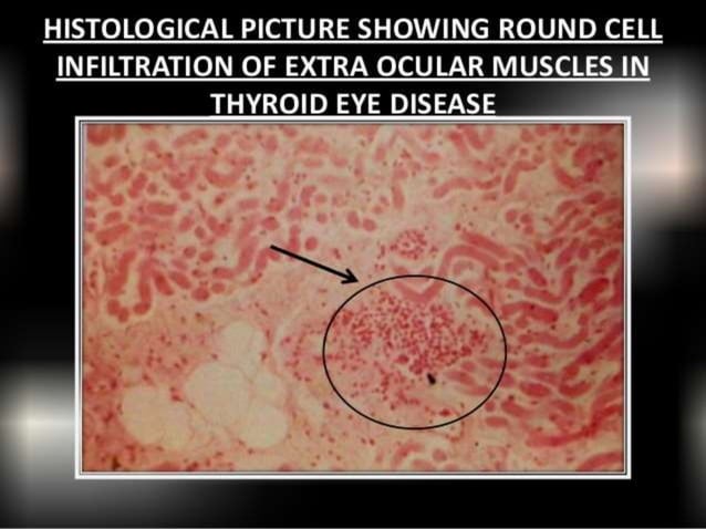 Thyroid eye disease | PPTX