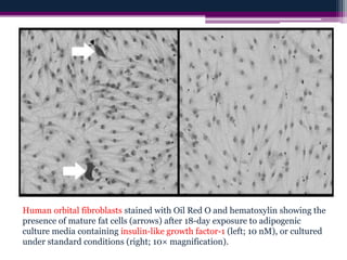 Human orbital fibroblasts stained with Oil Red O and hematoxylin showing the
presence of mature fat cells (arrows) after 18-day exposure to adipogenic
culture media containing insulin-like growth factor-1 (left; 10 nM), or cultured
under standard conditions (right; 10× magnification).
 