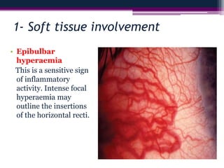1- Soft tissue involvement
• Epibulbar
hyperaemia
This is a sensitive sign
of inflammatory
activity. Intense focal
hyperaemia may
outline the insertions
of the horizontal recti.
 