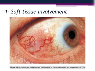 1- Soft tissue involvement
 