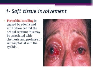 1- Soft tissue involvement
• Periorbital swelling is
caused by edema and
infiltration behind the
orbital septum; this may
be associated with
chemosis and prolapse of
retroseptal fat into the
eyelids.
 