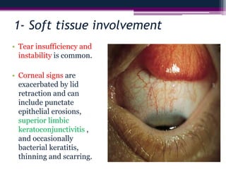 1- Soft tissue involvement
• Tear insufficiency and
instability is common.
• Corneal signs are
exacerbated by lid
retraction and can
include punctate
epithelial erosions,
superior limbic
keratoconjunctivitis ,
and occasionally
bacterial keratitis,
thinning and scarring.
 