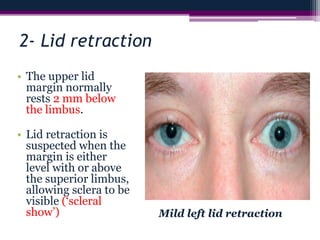 2- Lid retraction
• The upper lid
margin normally
rests 2 mm below
the limbus.
• Lid retraction is
suspected when the
margin is either
level with or above
the superior limbus,
allowing sclera to be
visible (‘scleral
show’) Mild left lid retraction
 