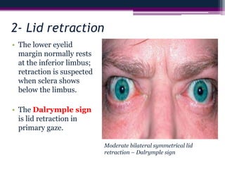 2- Lid retraction
• The lower eyelid
margin normally rests
at the inferior limbus;
retraction is suspected
when sclera shows
below the limbus.
• The Dalrymple sign
is lid retraction in
primary gaze.
Moderate bilateral symmetrical lid
retraction – Dalrymple sign
 