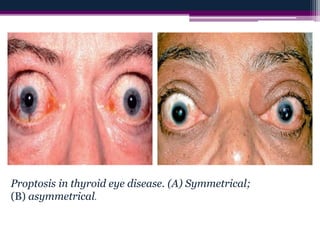 Proptosis in thyroid eye disease. (A) Symmetrical;
(B) asymmetrical.
 