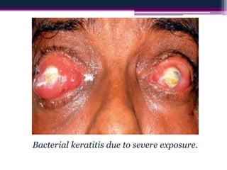 Bacterial keratitis due to severe exposure.
 