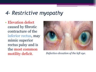 4- Restrictive myopathy
• Elevation defect
caused by fibrotic
contracture of the
inferior rectus, may
mimic superior
rectus palsy and is
the most common
motility deficit. Defective elevation of the left eye.
 