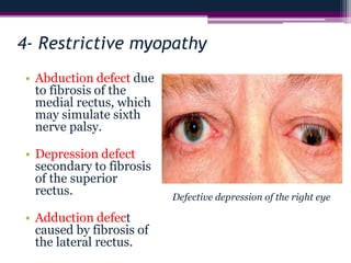 4- Restrictive myopathy
• Abduction defect due
to fibrosis of the
medial rectus, which
may simulate sixth
nerve palsy.
• Depression defect
secondary to fibrosis
of the superior
rectus.
• Adduction defect
caused by fibrosis of
the lateral rectus.
Defective depression of the right eye
 