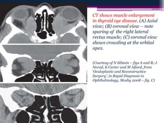 CT shows muscle enlargement
in thyroid eye disease. (A) Axial
view; (B) coronal view – note
sparing of the right lateral
rectus muscle; (C) coronal view
shows crowding at the orbital
apex.
(Courtesy of N Sibtain – figs A and B; J
Nerad, K Carter and M Alford, from
‘Oculoplastic and Reconstructive
Surgery’, in Rapid Diagnosis in
Ophthalmology, Mosby 2008 – fig. C)
 