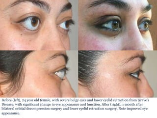 Before (left), 24 year old female, with severe bulgy eyes and lower eyelid retraction from Grave’s
Disease, with significant change in eye appearance and function. After (right), 1 month after
bilateral orbital decompression surgery and lower eyelid retraction surgery. Note improved eye
appearance.
 