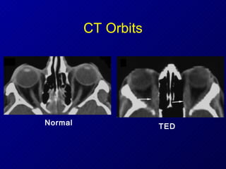 CT Orbits TED Normal 