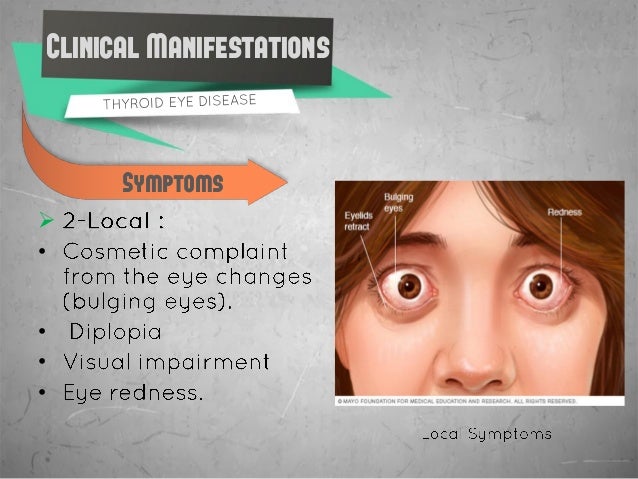Thyroid Eye Disease Verywell Health