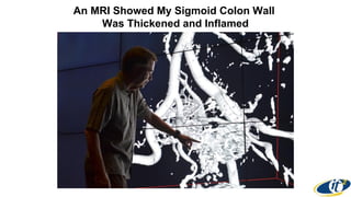 An MRI Showed My Sigmoid Colon Wall
Was Thickened and Inflamed
 