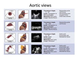Transesophageal Echocardiography(TEE) | PPTX