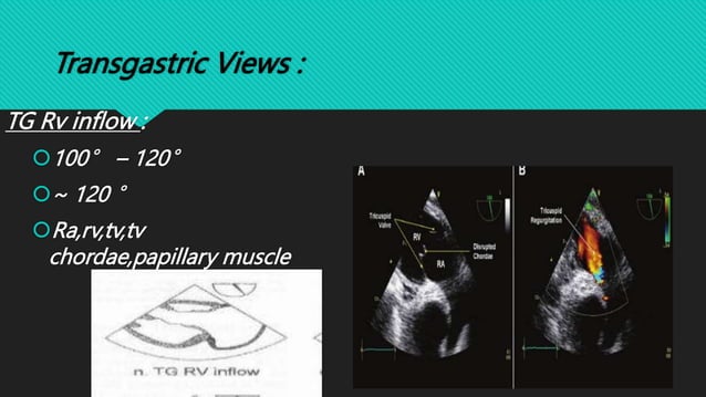 Tg Rv Inflow View Tee TRANSESOPHAGEAL ECHOCARDIOGRAPHY | PPT