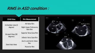 Ase Asd Rims TRANSESOPHAGEAL ECHOCARDIOGRAPHY | PPTX