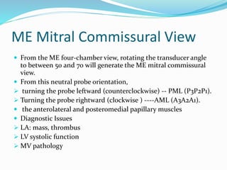ME Mitral Commissural View
 From the ME four-chamber view, rotating the transducer angle
to between 50 and 70 will generate the ME mitral commissural
view.
 From this neutral probe orientation,
 turning the probe leftward (counterclockwise) -- PML (P3P2P1).
 Turning the probe rightward (clockwise ) ----AML (A3A2A1).
 the anterolateral and posteromedial papillary muscles
 Diagnostic Issues
 LA: mass, thrombus
 LV systolic function
 MV pathology
 