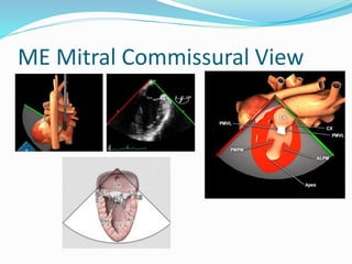 ME Mitral Commissural View
 