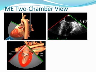 ME Two-Chamber View
 