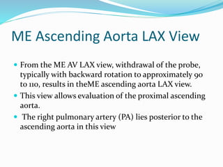 ME Ascending Aorta LAX View
 From the ME AV LAX view, withdrawal of the probe,
typically with backward rotation to approximately 90
to 110, results in theME ascending aorta LAX view.
 This view allows evaluation of the proximal ascending
aorta.
 The right pulmonary artery (PA) lies posterior to the
ascending aorta in this view
 