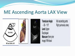 ME Ascending Aorta LAX View
 