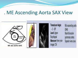 . ME Ascending Aorta SAX View
 