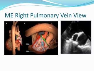 ME Right Pulmonary Vein View
 