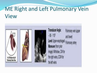 ME Right and Left Pulmonary Vein
View
 