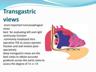 Transgastric
views
most important transesophageal
views
best for evaluating left and right
ventricular function
commonly employed intra
operative TEE to assess ejection
fraction and wall motion post-
operatively
deep transgastric views are the
best views to obtain accurate
gradients across the aortic valve to
assess the degree of AS or AR
 