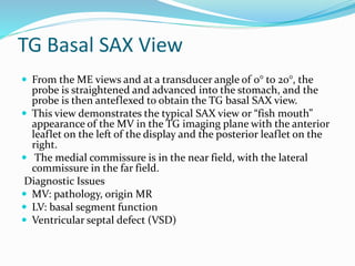 TG Basal SAX View
 From the ME views and at a transducer angle of 0° to 20°, the
probe is straightened and advanced into the stomach, and the
probe is then anteflexed to obtain the TG basal SAX view.
 This view demonstrates the typical SAX view or “fish mouth”
appearance of the MV in the TG imaging plane with the anterior
leaflet on the left of the display and the posterior leaflet on the
right.
 The medial commissure is in the near field, with the lateral
commissure in the far field.
Diagnostic Issues
 MV: pathology, origin MR
 LV: basal segment function
 Ventricular septal defect (VSD)
 
