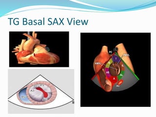 TG Basal SAX View
 