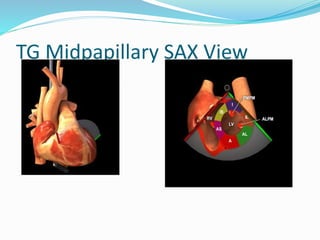 TG Midpapillary SAX View
 