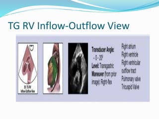 TG RV Inflow-Outflow View
 