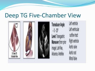 Deep TG Five-Chamber View
 