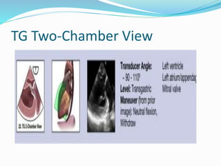 TG Two-Chamber View
 