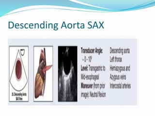 Descending Aorta SAX
 