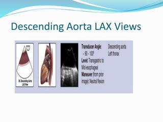 Descending Aorta LAX Views
 