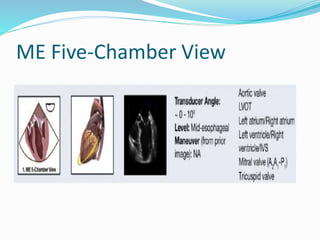 ME Five-Chamber View
 