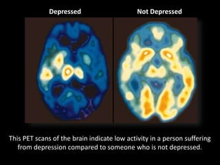 Depressed Not Depressed
This PET scans of the brain indicate low activity in a person suffering
from depression compared to someone who is not depressed.
 