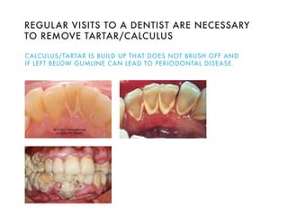Dental Health Presentation: For Teens | PDF