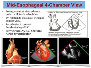 Mid-Esophageal 4-Chamber View
• From 5-chamber view, advance
probe until Aortic valve is lost.
• 150 rotation to maximize tricuspid
annular view.
• Retroflexion to prevent
foreshortening of LV.
• For Viewing: LV, RV, Septum :
Atrial & ventricular
 
