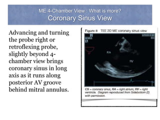 ME 4-Chamber View : What is more?
Coronary Sinus View
Advancing and turning
the probe right or
retroflexing probe,
slightly beyond 4-
chamber view brings
coronary sinus in long
axis as it runs along
posterior AV groove
behind mitral annulus.
 