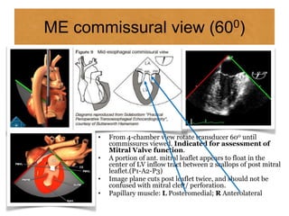 ME commissural view (600)
• From 4-chamber view rotate transducer 600 until
commissures viewed. Indicated for assessment of
Mitral Valve function.
• A portion of ant. mitral leaflet appears to float in the
center of LV inflow tract between 2 scallops of post mitral
leaflet.(P1-A2-P3)
• Image plane cuts post leaflet twice, and should not be
confused with mitral cleft/ perforation.
• Papillary muscle: L Posteromedial; R Anterolateral
 
