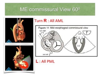 ME commissural View 600
• Turn R : All AML
Turn L : All PML
 
