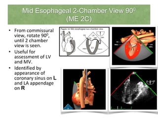 Mid Esophageal 2-Chamber View 900
(ME 2C)
• From commissural
view, rotate 900,
until 2 chamber
view is seen.
• Useful for
assessment of LV
and MV.
• Identified by
appearance of
coronary sinus on L
and LA appendage
on R
 