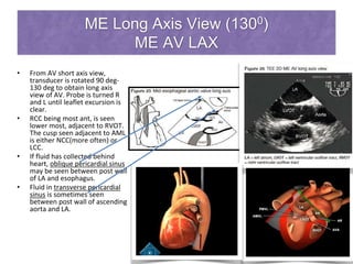 ME Long Axis View (1300)
ME AV LAX
• From AV short axis view,
transducer is rotated 90 deg-
130 deg to obtain long axis
view of AV. Probe is turned R
and L until leaflet excursion is
clear.
• RCC being most ant, is seen
lower most, adjacent to RVOT.
The cusp seen adjacent to AML
is either NCC(more often) or
LCC.
• If fluid has collected behind
heart, oblique pericardial sinus
may be seen between post wall
of LA and esophagus.
• Fluid in transverse pericardial
sinus is sometimes seen
between post wall of ascending
aorta and LA.
 