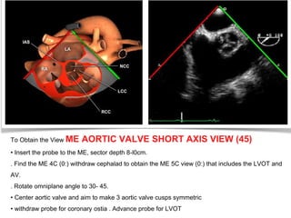 To Obtain the View ME AORTIC VALVE SHORT AXIS VIEW (45)
• Insert the probe to the ME, sector depth 8-l0cm.
. Find the ME 4C (0:) withdraw cephalad to obtain the ME 5C view (0:) that includes the LVOT and
AV.
. Rotate omniplane angle to 30- 45.
• Center aortic valve and aim to make 3 aortic valve cusps symmetric
• withdraw probe for coronary ostia . Advance probe for LVOT
 