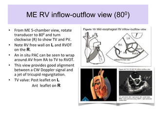 ME RV inflow-outflow view (800)
• From ME 5-chamber view, rotate
transducer to 800 and turn
clockwise (R) to show TV and PV.
• Note RV free wall on L and RVOT
on the R.
• An in situ PAC can be seen to wrap
around AV from RA to TV to RVOT.
• This view provides good alignment
between a CW Doppler signal and
a jet of tricupid regurgitation.
• TV valve: Post leaflet on L
Ant leaflet on R
 