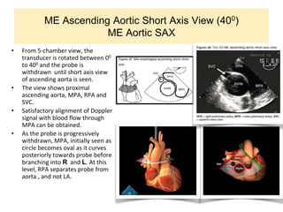 ME Ascending Aortic Short Axis View (400)
ME Aortic SAX
• From 5-chamber view, the
transducer is rotated between 00
to 400 and the probe is
withdrawn until short axis view
of ascending aorta is seen.
• The view shows proximal
ascending aorta, MPA, RPA and
SVC.
• Satisfactory alignment of Doppler
signal with blood flow through
MPA can be obtained.
• As the probe is progressively
withdrawn, MPA, initially seen as
circle becomes oval as it curves
posteriorly towards probe before
branching into R and L. At this
level, RPA separates probe from
aorta , and not LA.
 