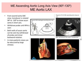 ME Ascending Aortic Long Axis View (900-1300)
ME Aortic LAX
• From ascend aorta SAX
view, transducer is rotated
900 to 1300 to show ascen
aorta in short axis.
• Withdraw probe until RPA is
seen
• Both walls of ascen aorta
can be seen by withdrawal
of probe and minor
backward rotation.
• In many patients views can
be obscured by large
airways.
 